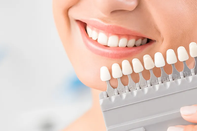 Zahnzusatz-Versicherung – Frau mit Zahnfarbskala zur Auswahl passender Veneers beim Zahnarzt